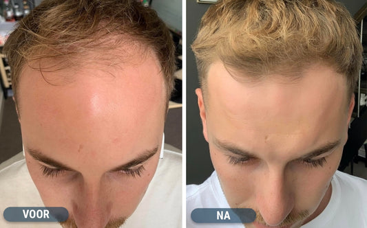 Minoxidil resultaten